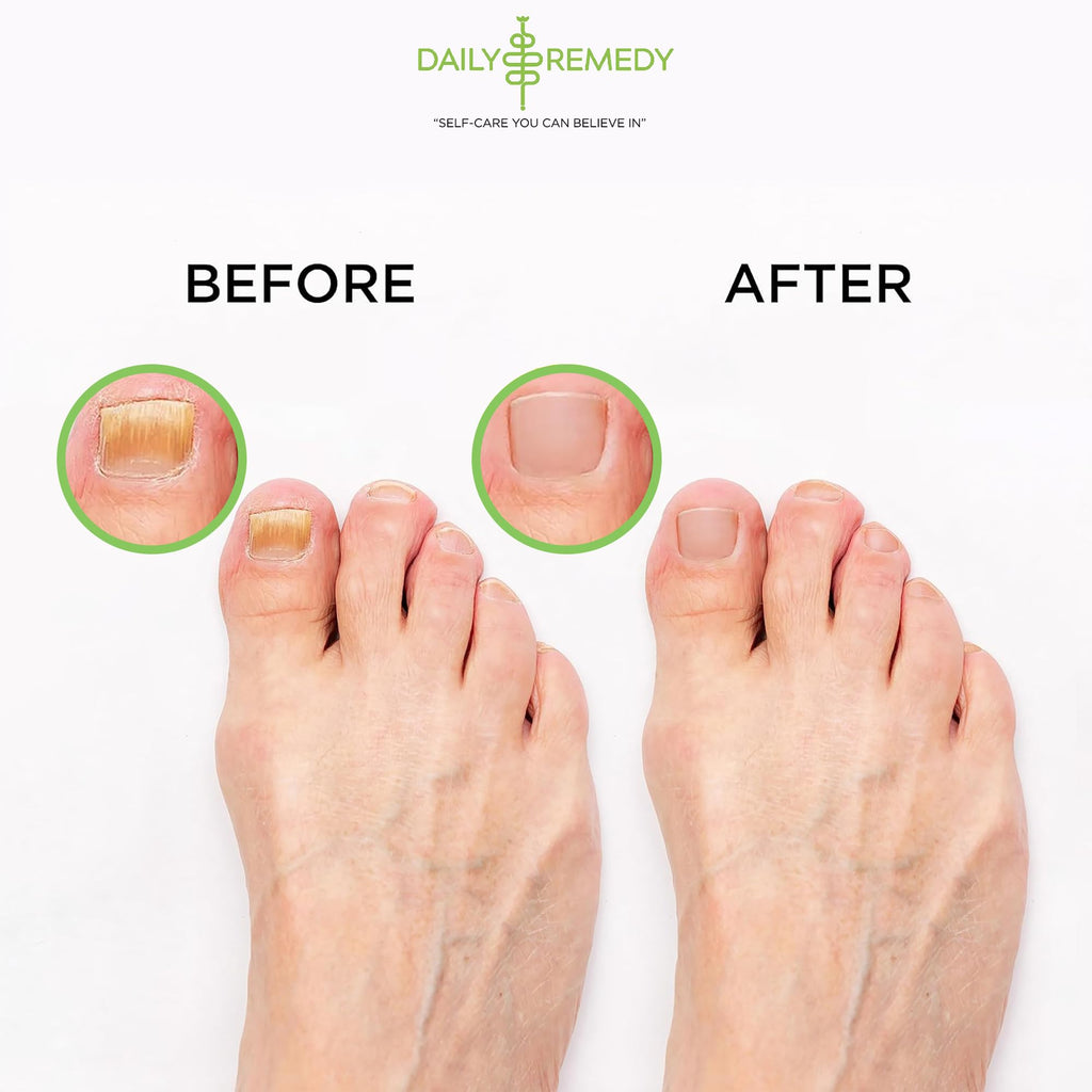 Tea Tree Oil Foot Soak with Epsom Salt - Made in USA - for Toenail Athletes Foot DAILY REMEDYBuy Supplements Australia