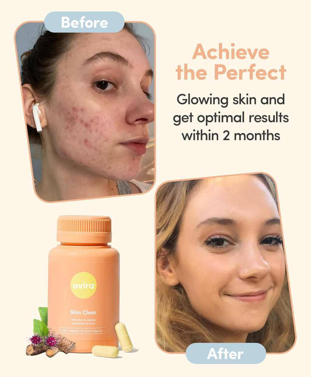 Ovira Skin Clear with ZINCBRIGHT - 60 Capsules for Clear and Glowing Skin | Rosacea & Hormonal Acne Treatment | Support Collagen Production | Acne Supplements for Women & Men - Pack of 2 OviraBuy Supplements Australia