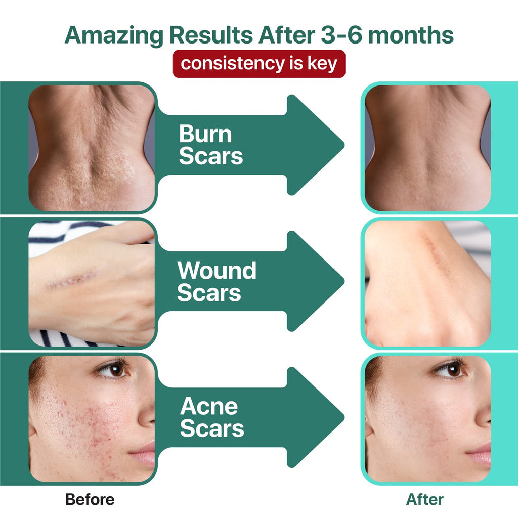Ebanel Bundle of 30% AHA 2% BHA Chemical Peel and Advanced Silicone Scar Gel Ebanel buy supplements Au