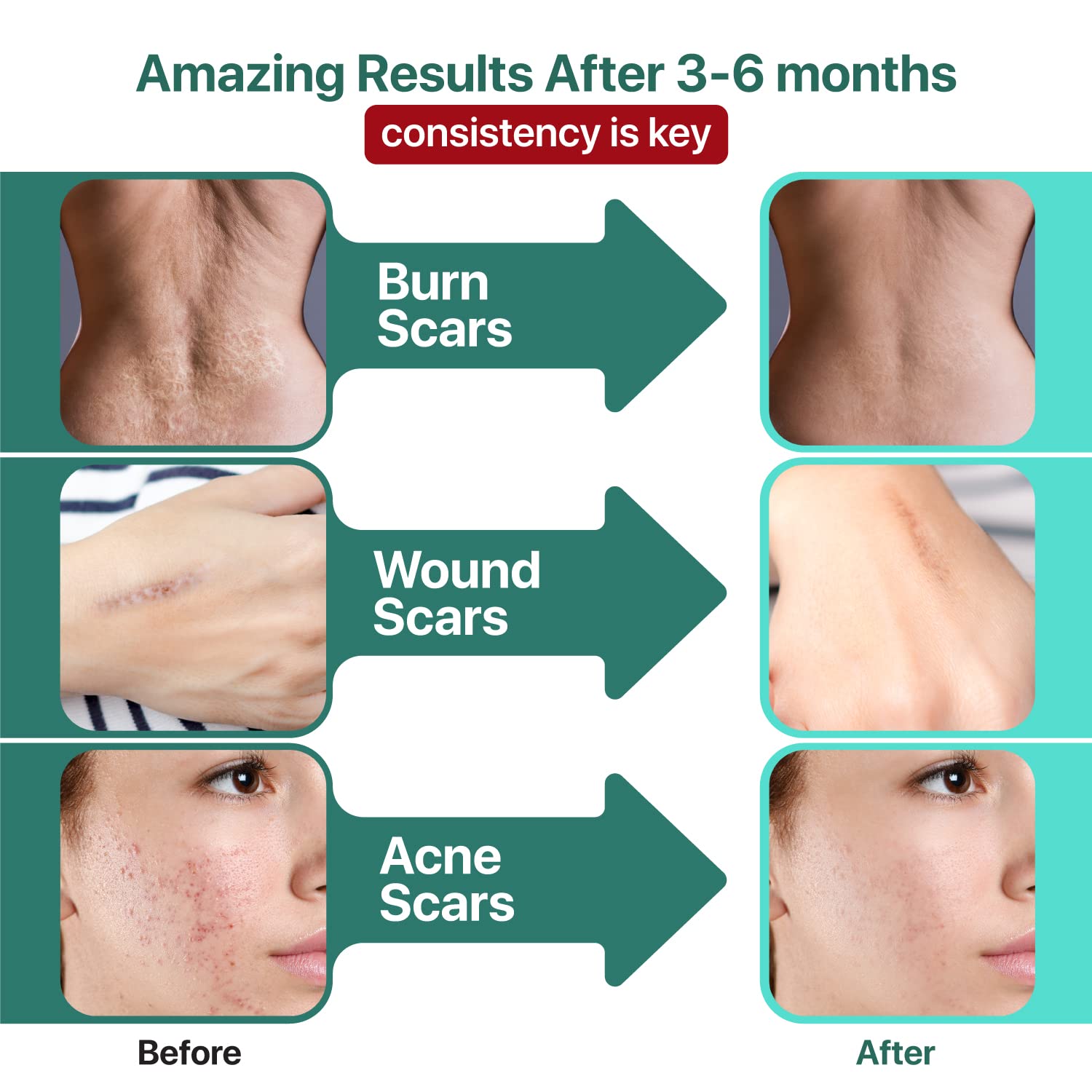 Ebanel Bundle of 30% AHA 2% BHA Chemical Peel and Advanced Silicone Scar Gel Ebanel buy supplements Au