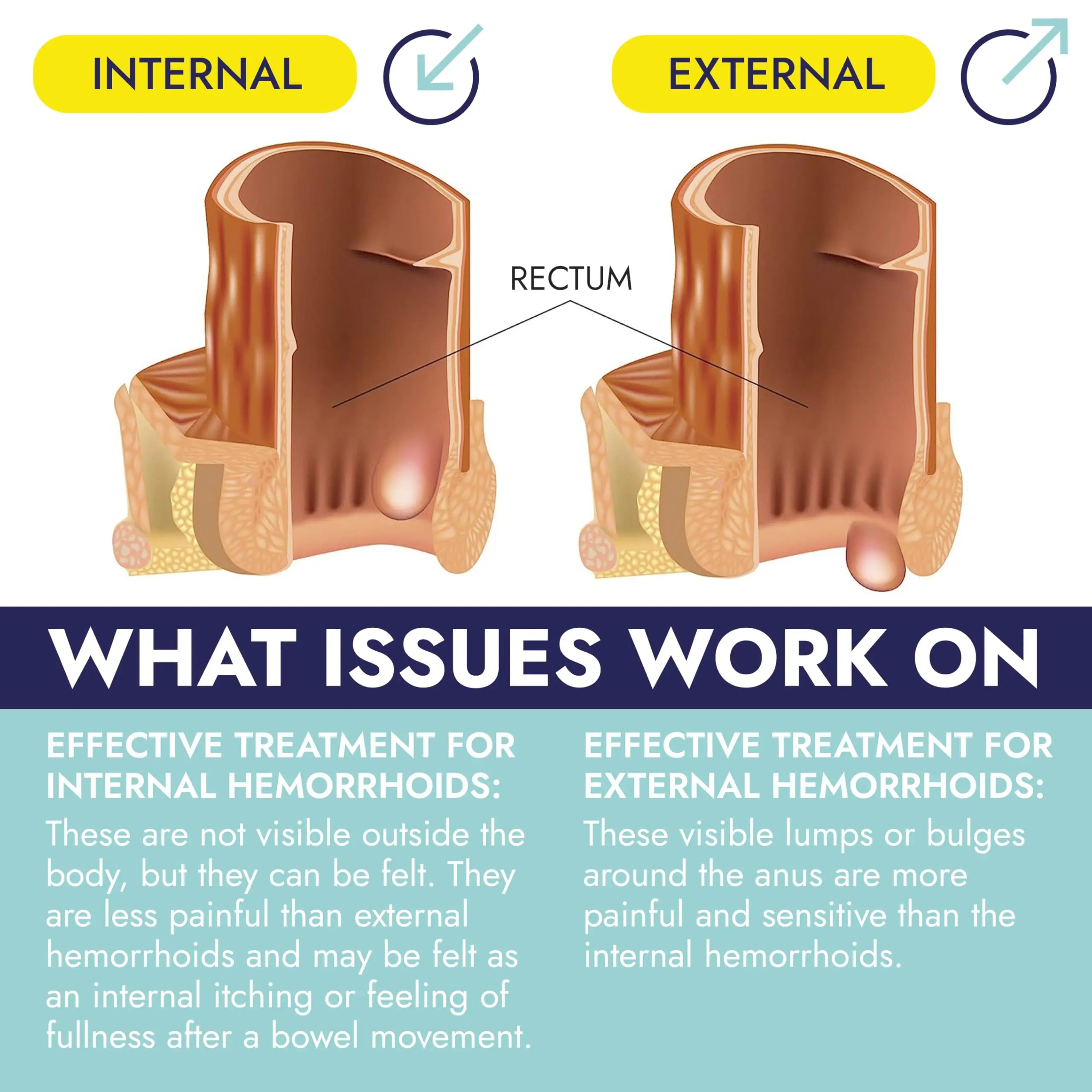 Hemorrhoid Treatment | Hemorrhoid Ointment | Hemorrhoid & Fissure Ointment | 7 Pre-Filled Applicators | Fast & Effective Relief | Reduces Swelling, Itching & Discomfort | Advanced Formula Terramed Just Think ComfortBuy Supplements Australia