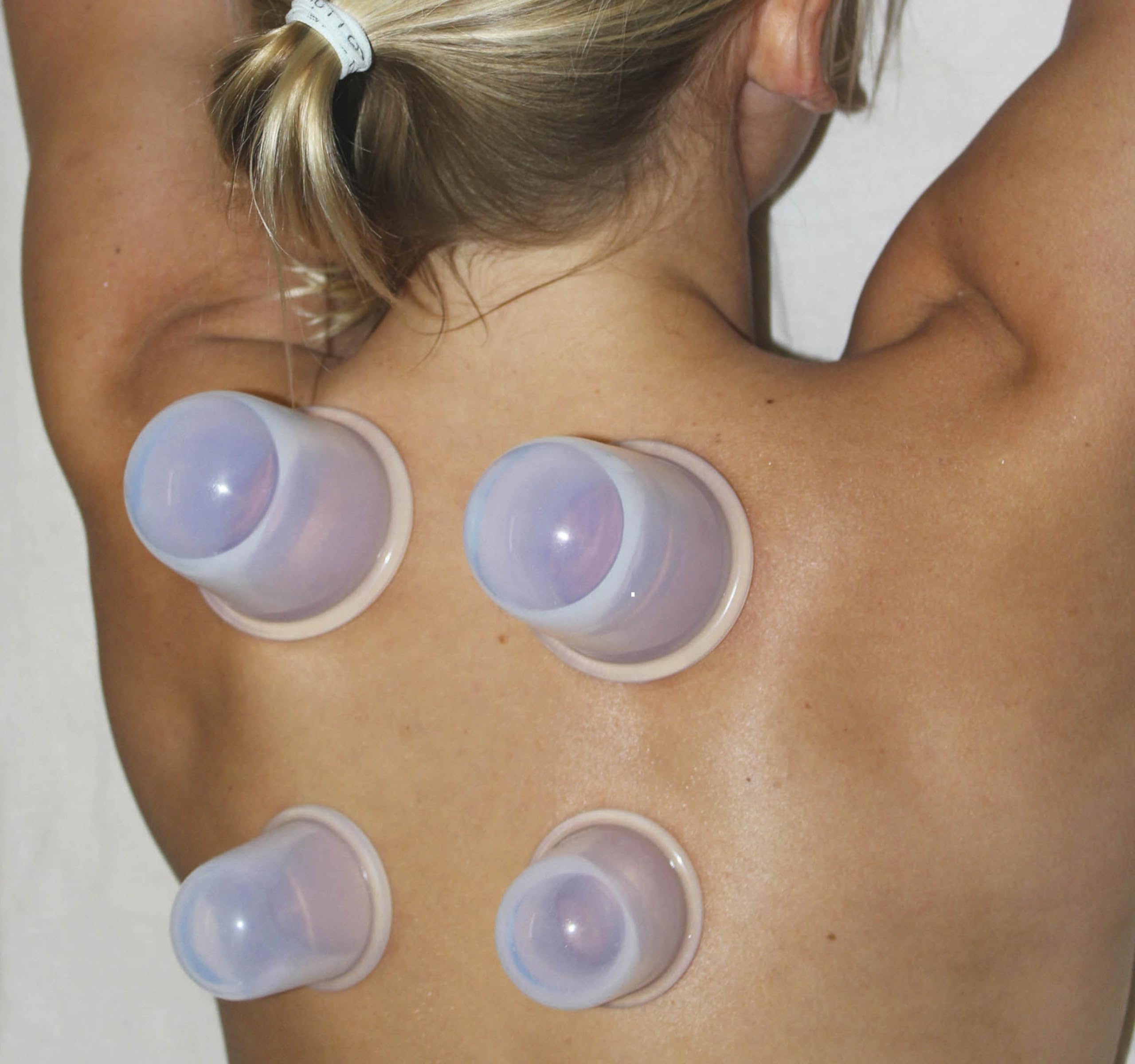 Cupping Kit for Massage Therapy - by DoSensePro, Cupping Set of 6 Professional Silicone Cups DoSenseProBuy Supplements Australia